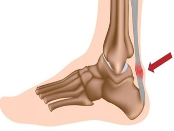 Viêm gân gót chân hay còn gọi là viêm gân Achilles