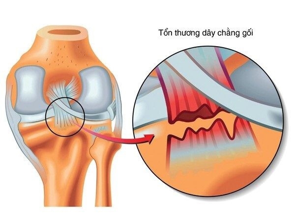 Chấn thương dây chằng chéo trước là một trong những chấng thương nghiêm trọng