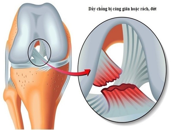 Giãn dây chằng đầu gối là chấn thương khá nghiêm trọng