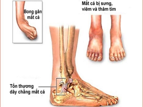 Các bệnh lý gây ra chấn thương cổ chân khi đá bóng